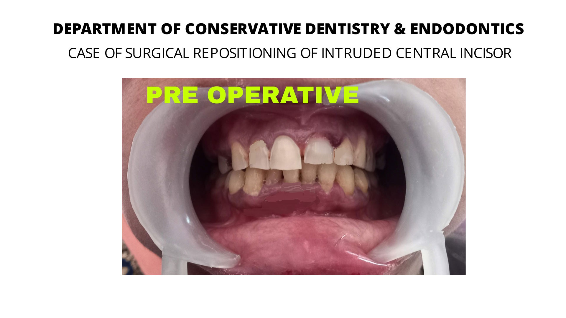 endodontics-case