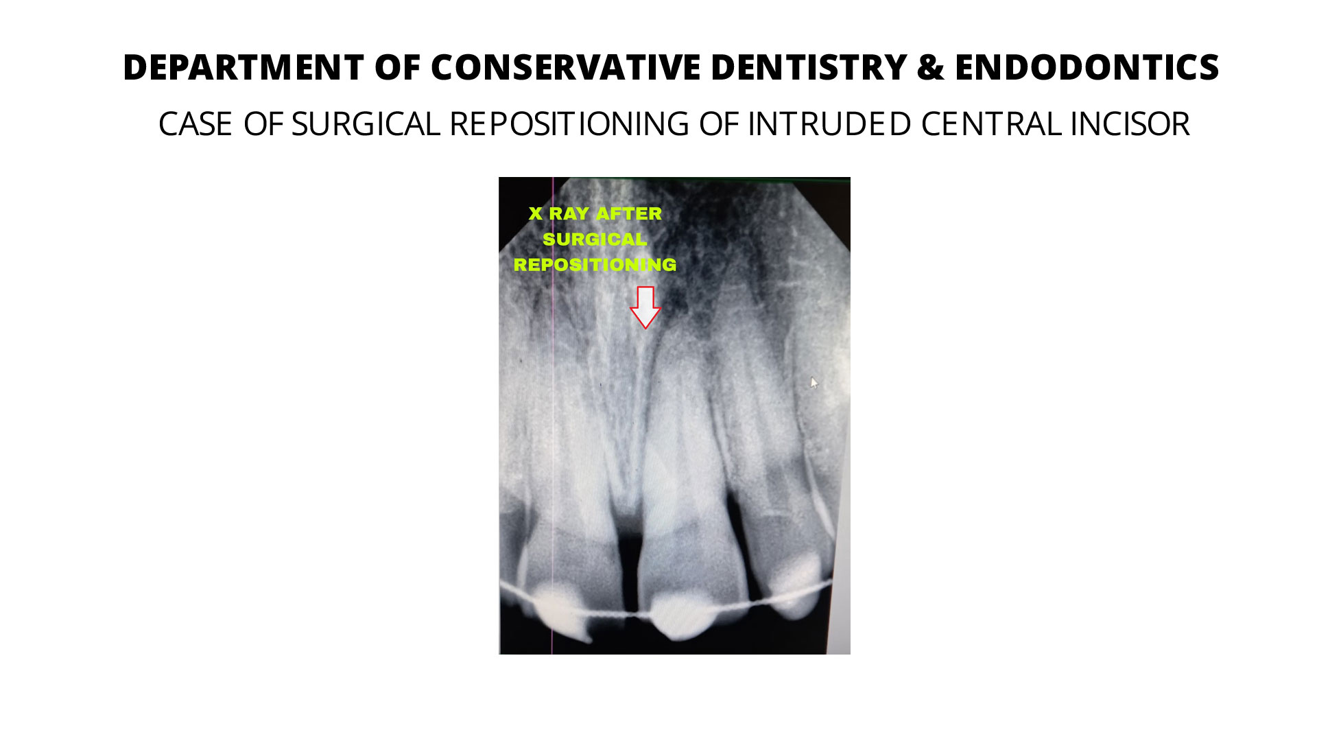 endodontics-case